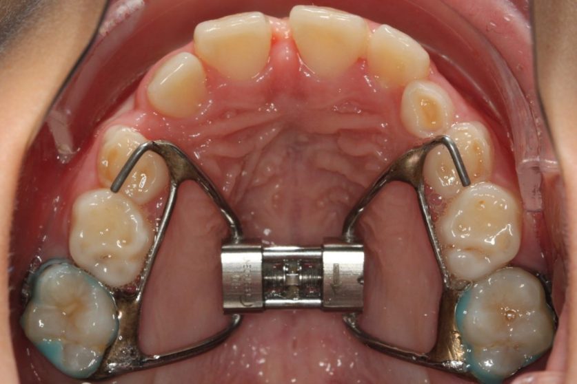 Can Adults Use Palate Expander? Drop Article