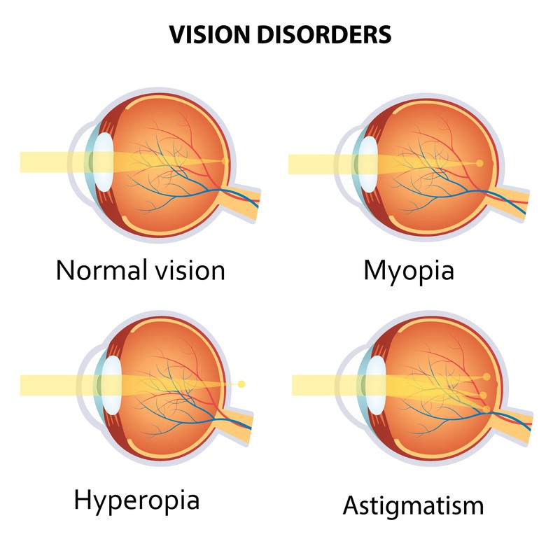 Refractive Errors Image